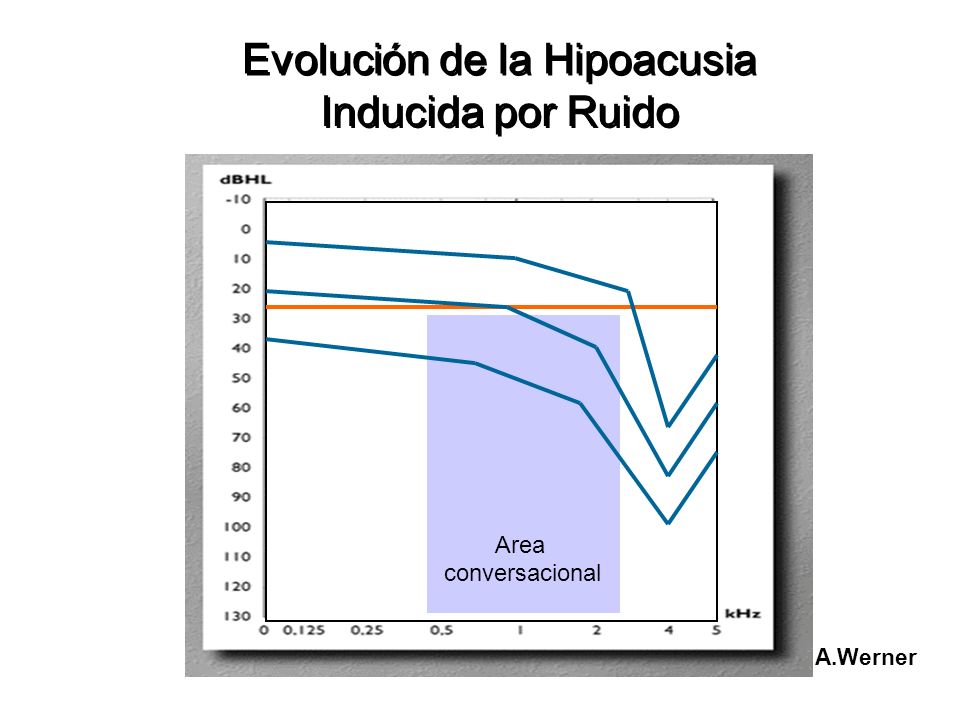 hipoacusia inducida por ruido